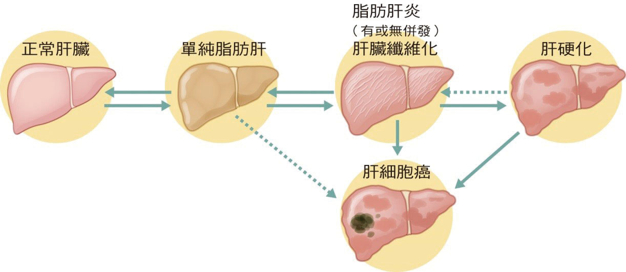 分院報導 基隆分院 肝纖維化和肝纖維化掃描儀